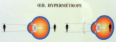 Les amétropies ou défauts de mesure de l'oeil