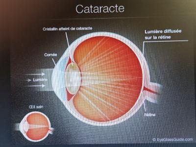 La Cataracte: qu'est-ce que la cataracte de l'oeil ? Votre opticien sur Nice vous explique.